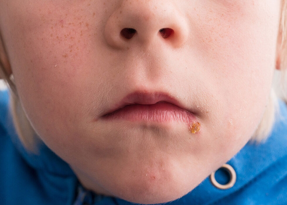 childs mouth with impetigo breakout.