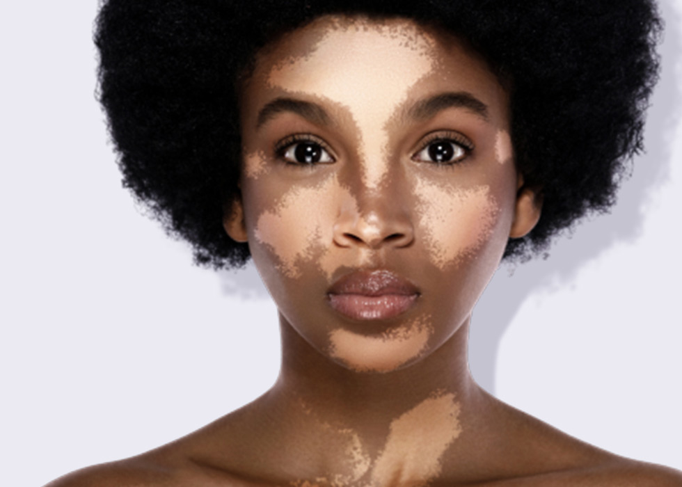 vitiligo on woman's face and chest.