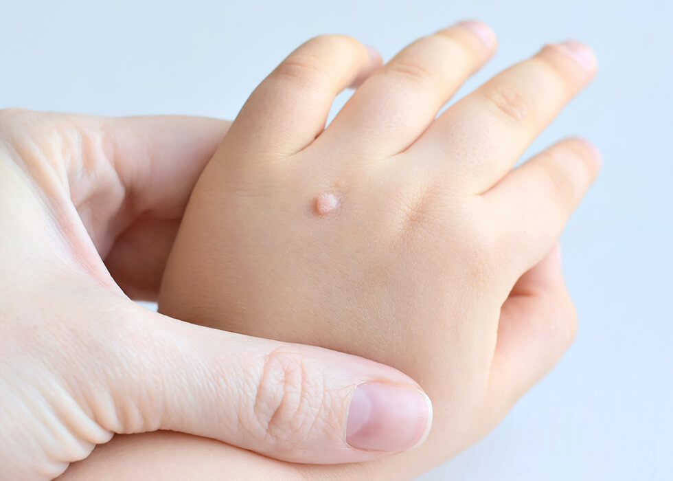 wart on child's hand.